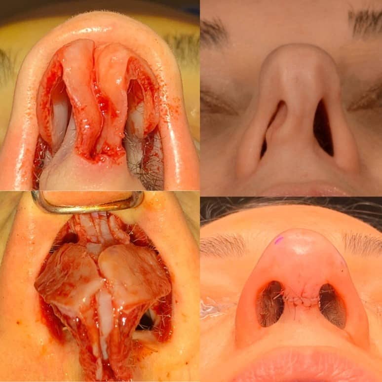 Breathing Problems After Rhinoplasty: What to Expect & Fix