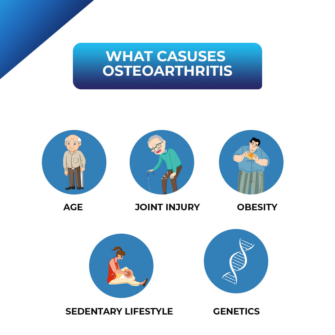 Causes of Osteoarthritis Explained: A Friendly Guide
