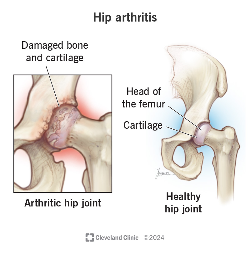 Does Losing Weight Help Arthritis in the Hip?