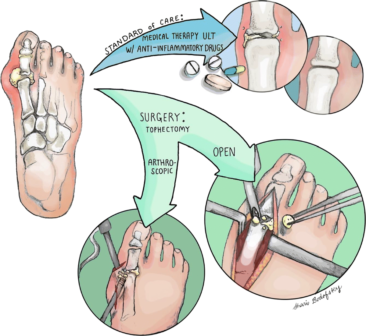 Gout Crystals Removal Surgery: Options, Costs & Recovery