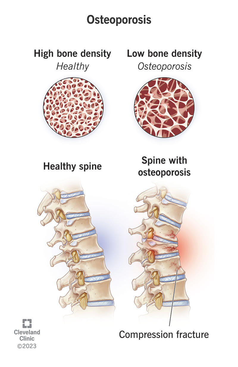Is Osteoporosis Hereditary in Women? Facts You Need