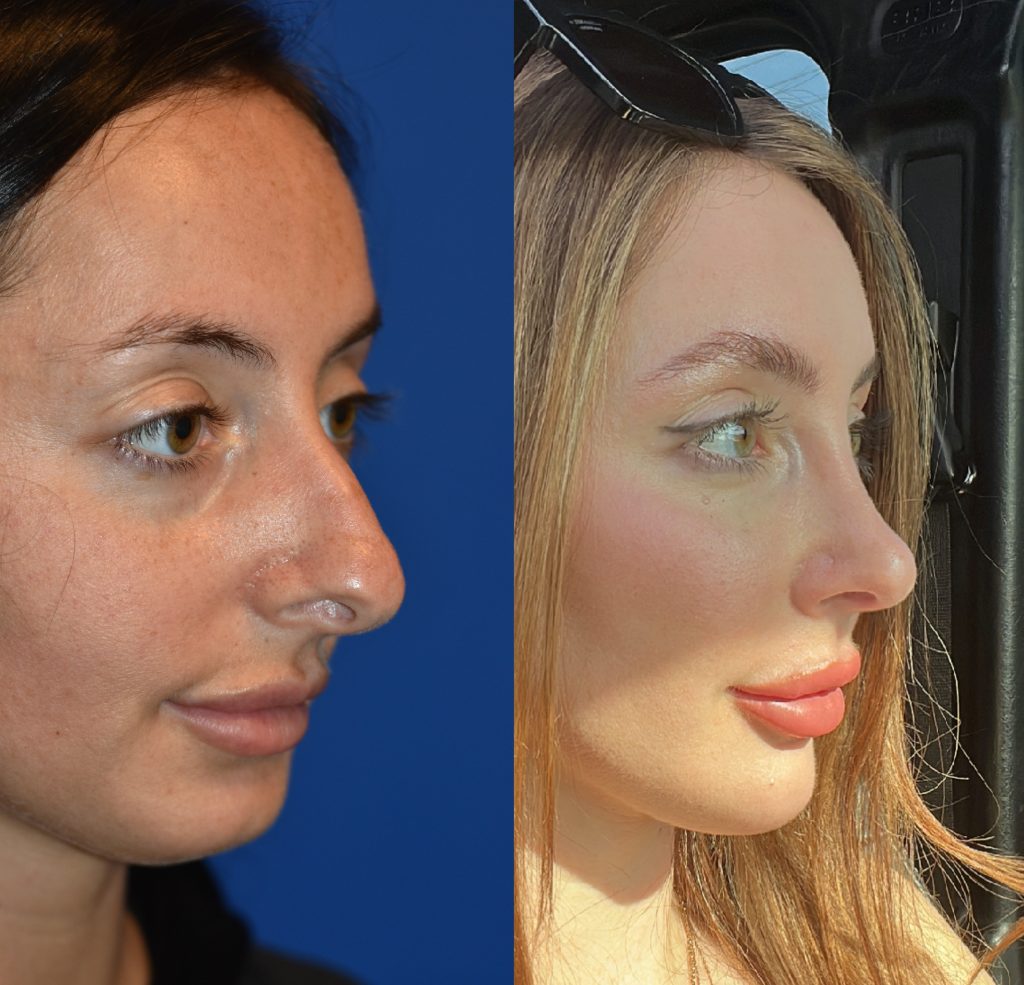 Is Rhinoplasty Dangerous? Risks, Benefits & Facts