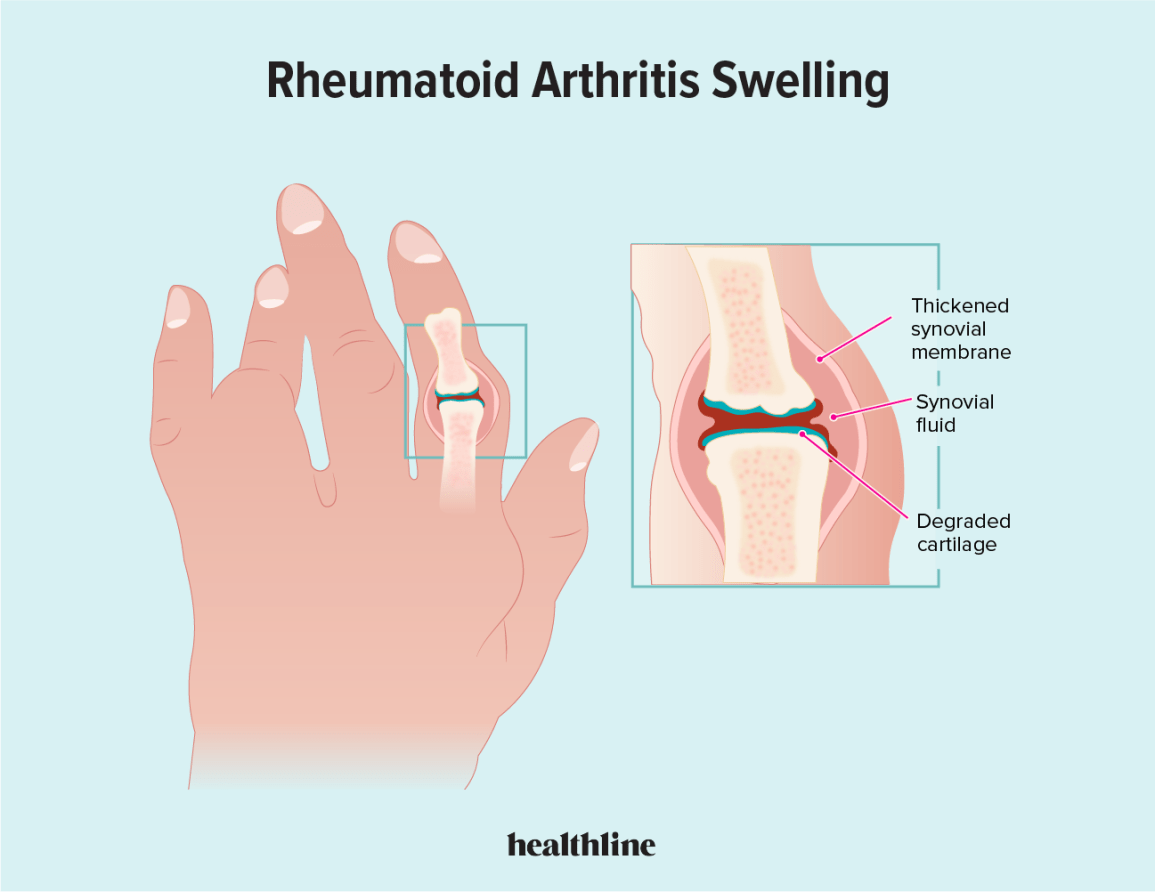 Joint Swelling Causes: Quick Answers & Effective Relief