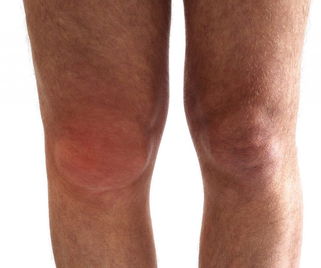 Joint Swelling Knee: Causes, Risks & Fast Relief