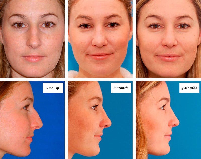 Nose Surgery Recovery Time: What to Expect & Speed Up