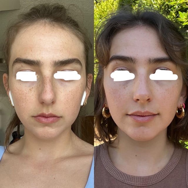 Septoplasty Cost Reddit: Real Prices & Practical Tips