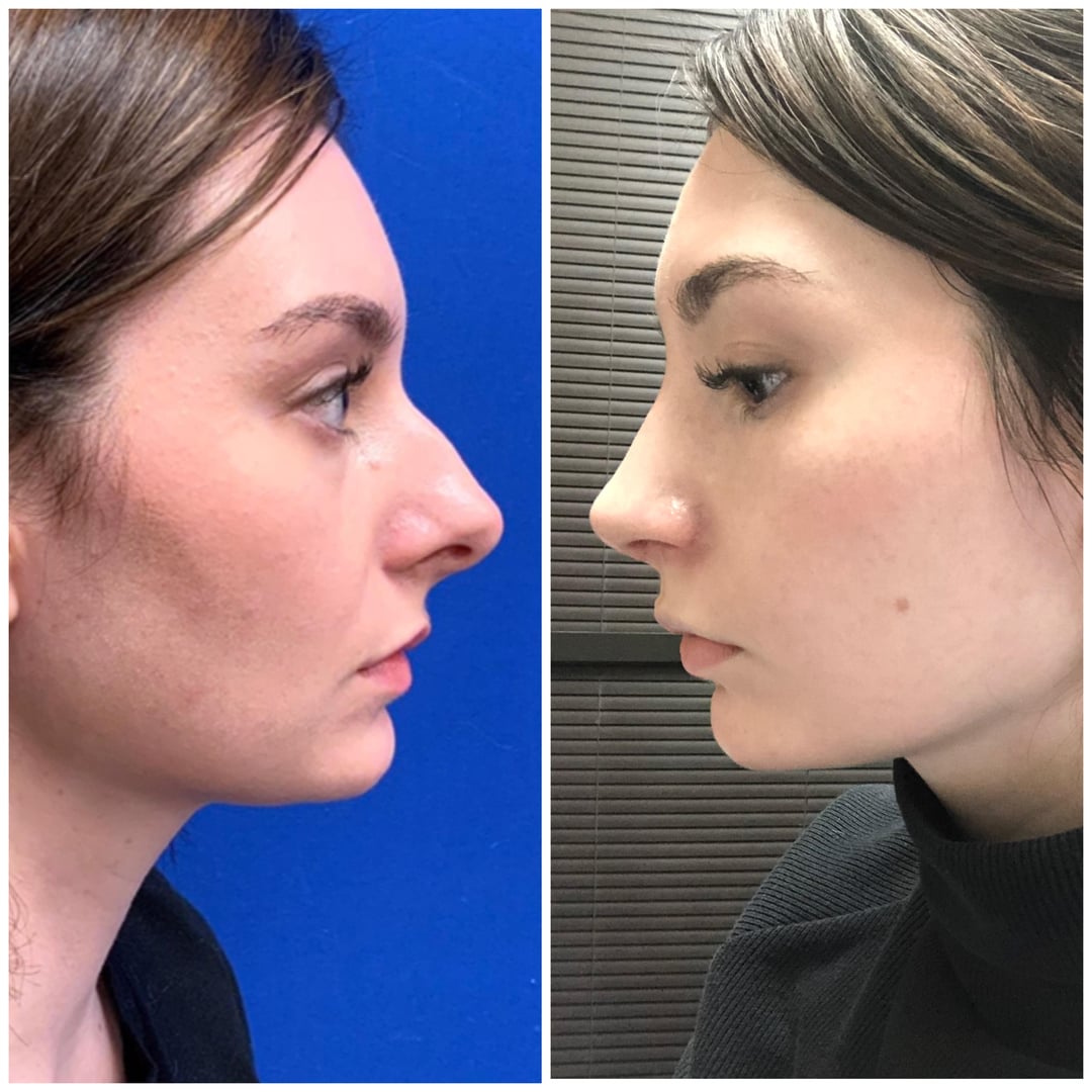 Septoplasty Cost with Insurance Reddit: Real Tips