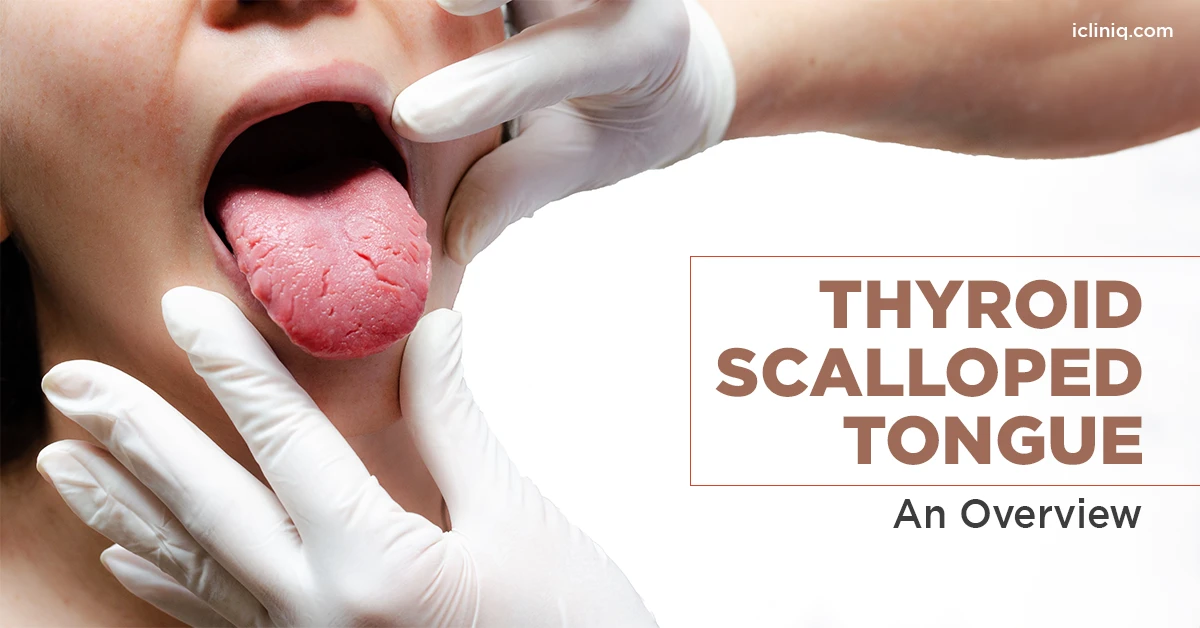 Thyroid Tongue Pictures: What Your Tongue Says