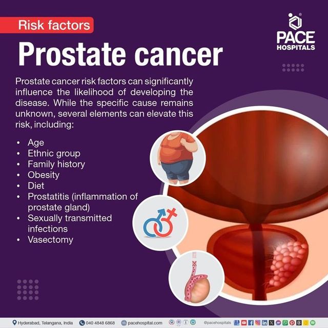 What Are the 10 Causes of Prostate Cancer? Explained