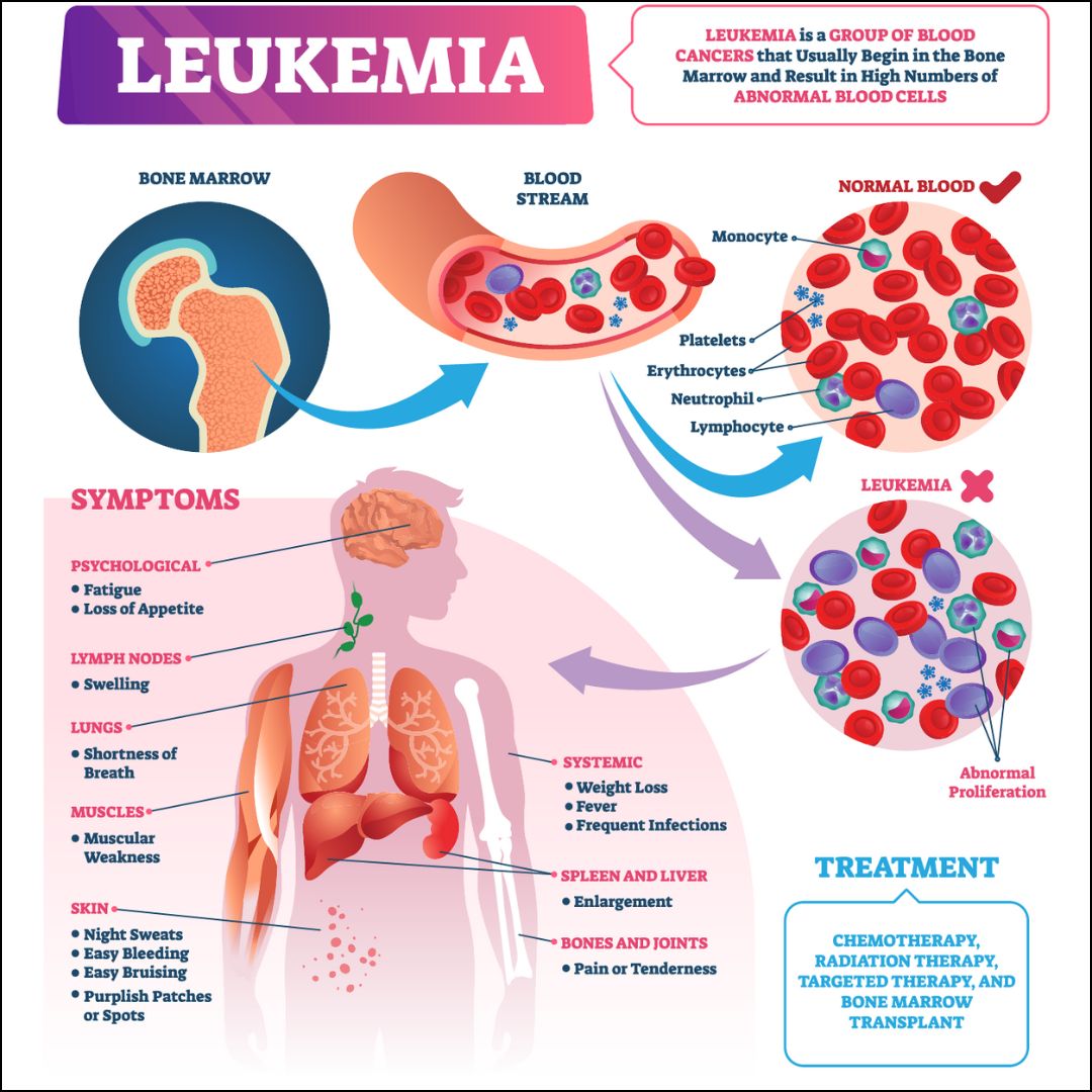 What Causes Leukemia? Uncovering the Real Risk Factors
