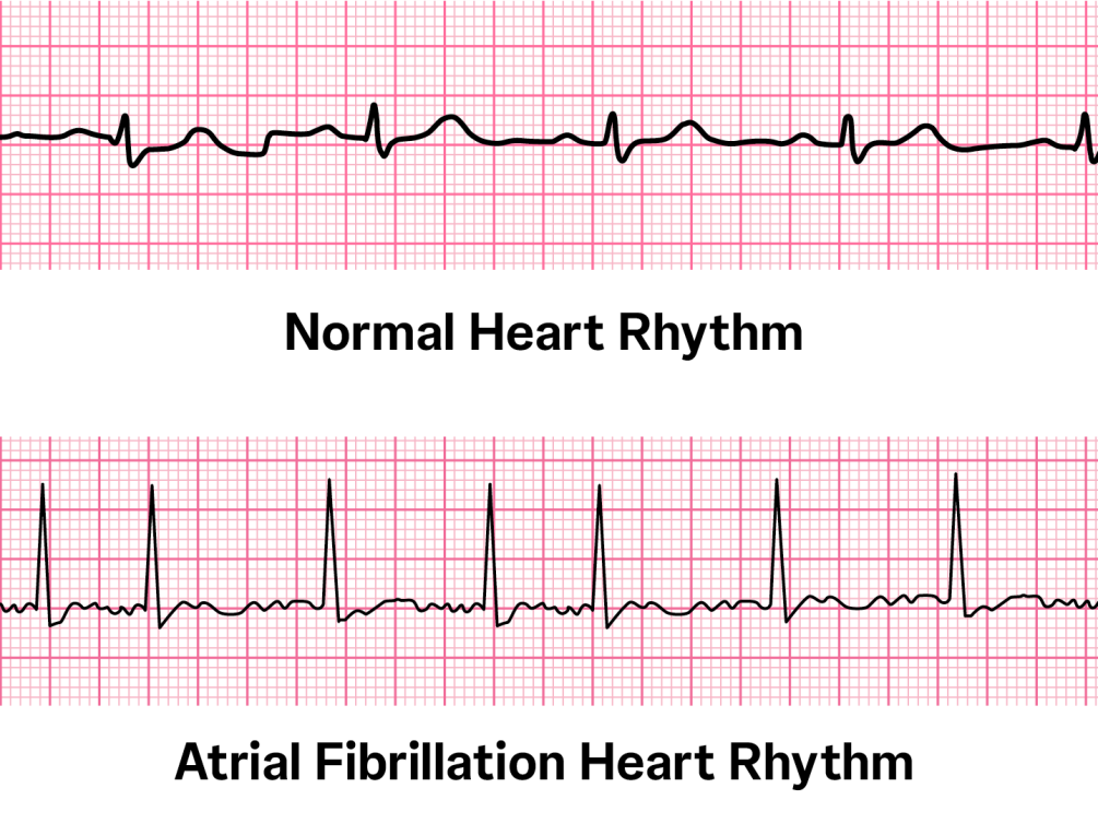 What is a Normal Heart Rate for Someone with A-Fib?