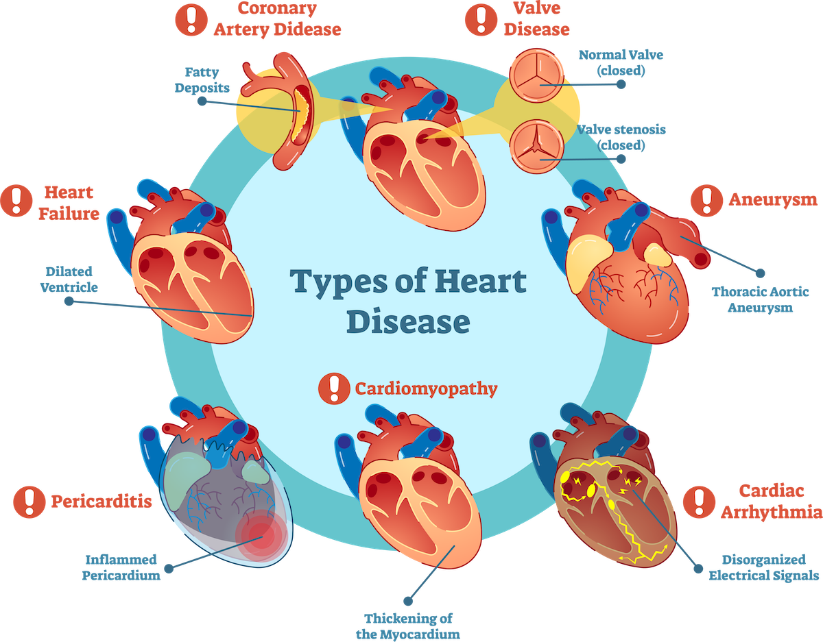 4 Types of Heart Disease You Need to Know – Stay Safe