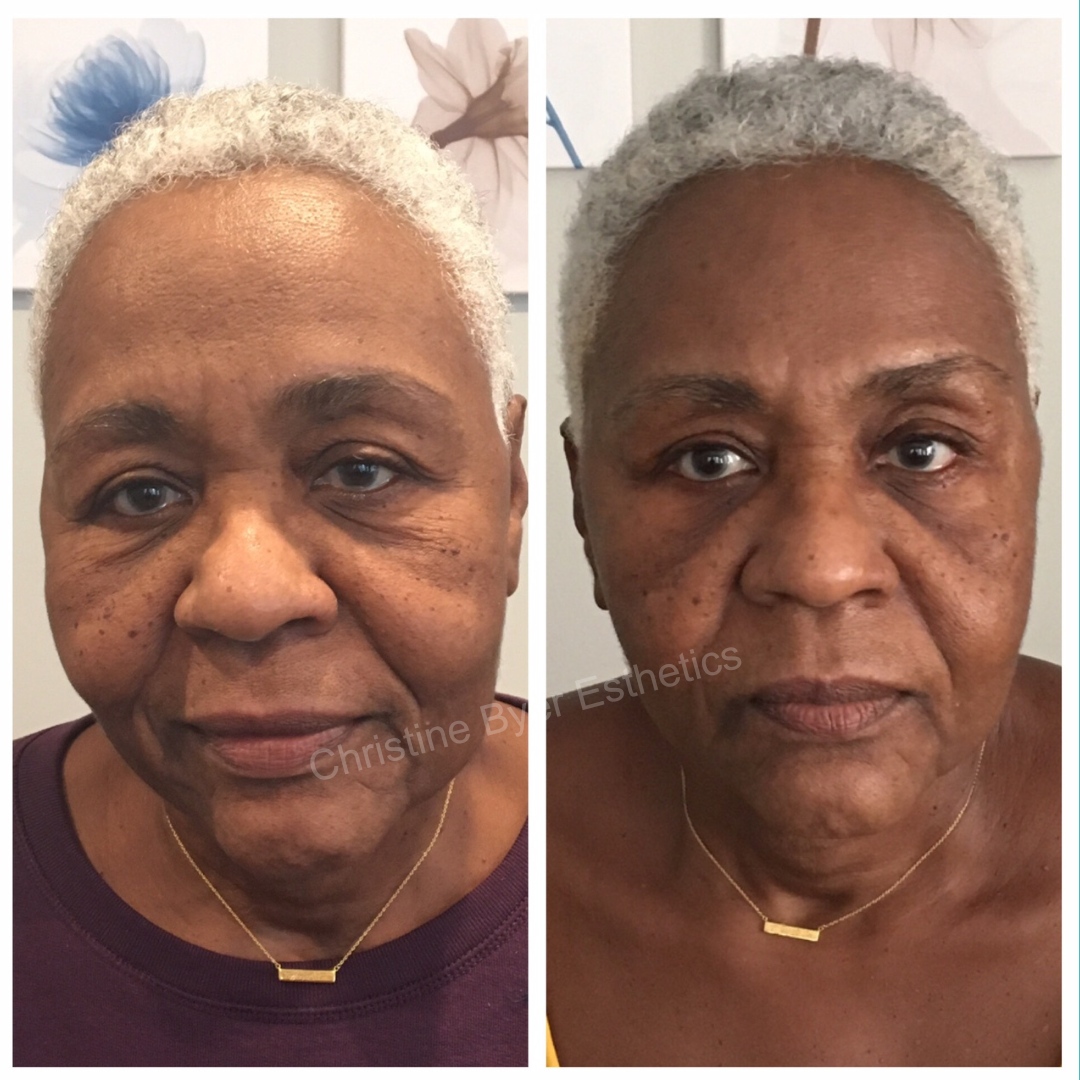 Anti Aging Facial Before and After: Real Results
