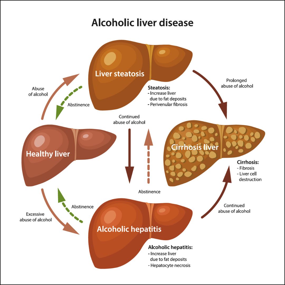 Blood Transfusion for Alcoholic Liver Disease: Key Facts