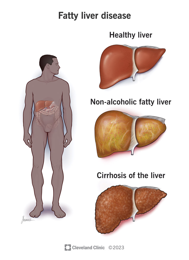 Can You Die from Fatty Liver Disease? Facts & Risks