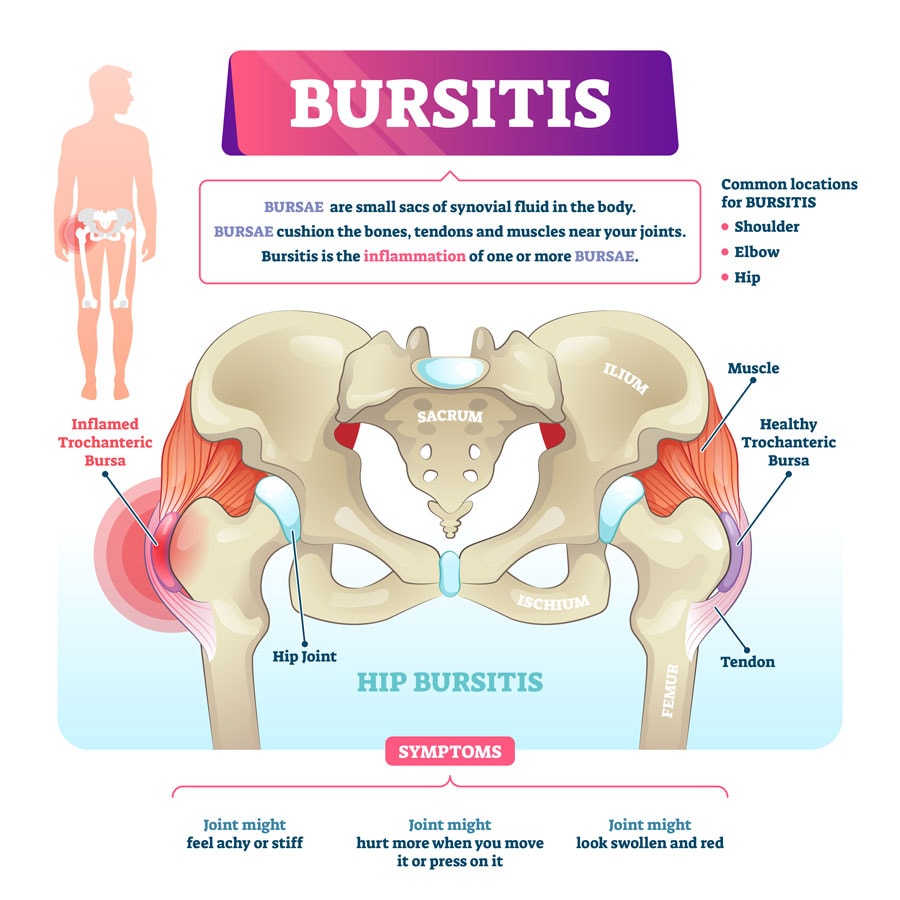 Coffee and Bursitis – Benefits, Risks & Management