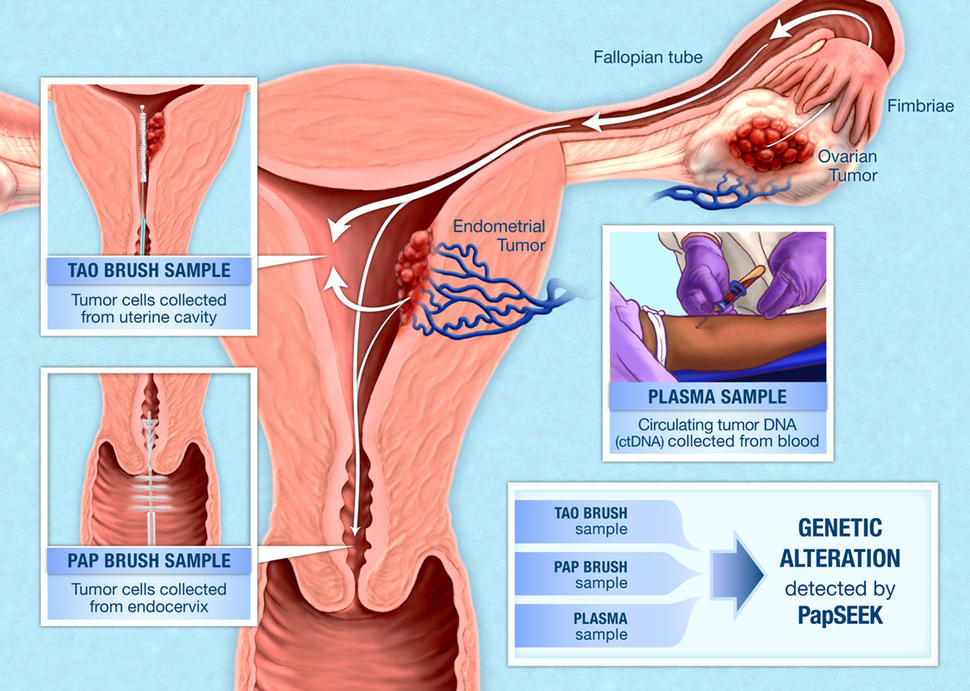 How Is Ovarian Cancer Diagnosed Early? A Friendly Guide
