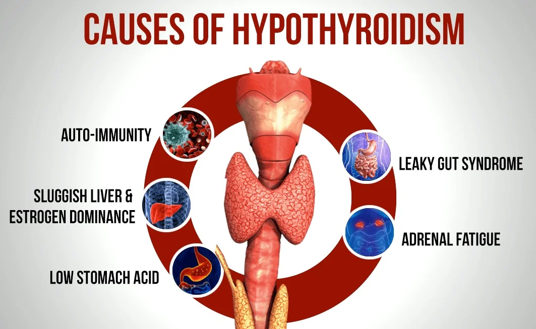 Hypothyroidism Causes – What’s Behind an Underactive Thyroid?