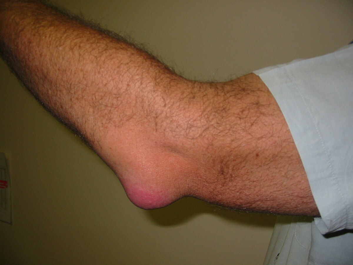 Infected Elbow Bursitis Pictures: What They Reveal