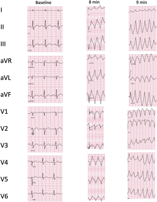 Is Exercise‑Induced Arrhythmia Dangerous? Find Out Here