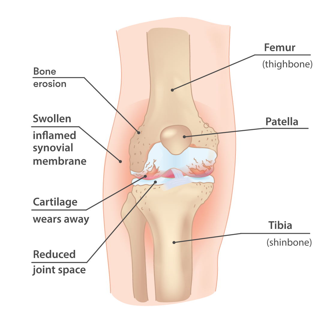 Why Joint Pain at Night Can Feel So Intensely Bad