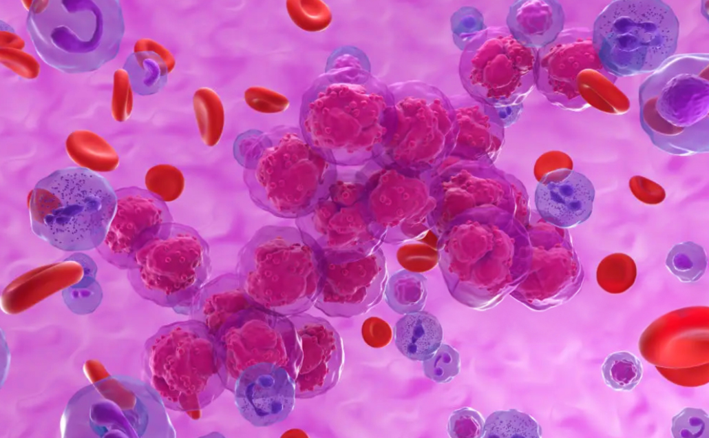 Leukemia Explained: Symptoms, Types, Causes & Treatment