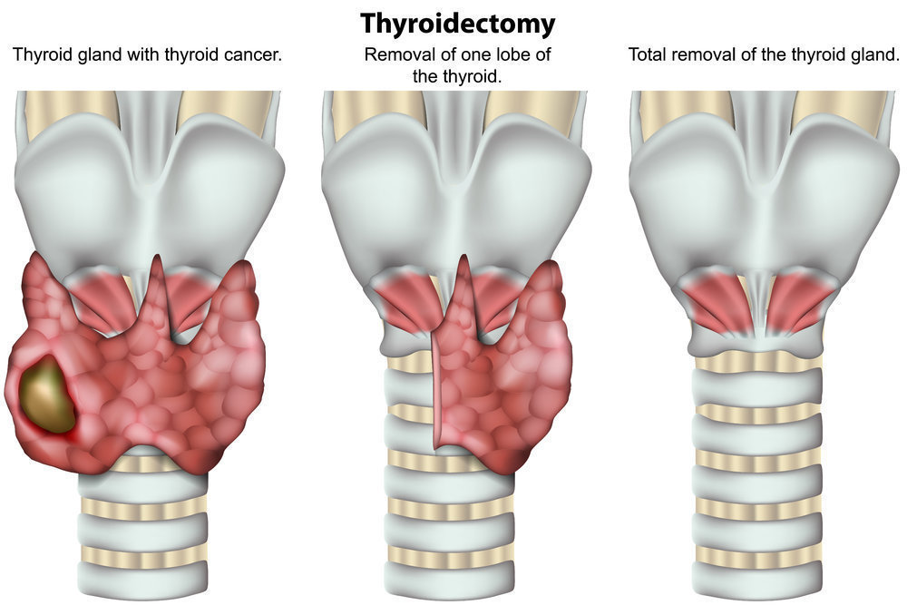 Papillary Thyroid Cancer Treatment After Surgery