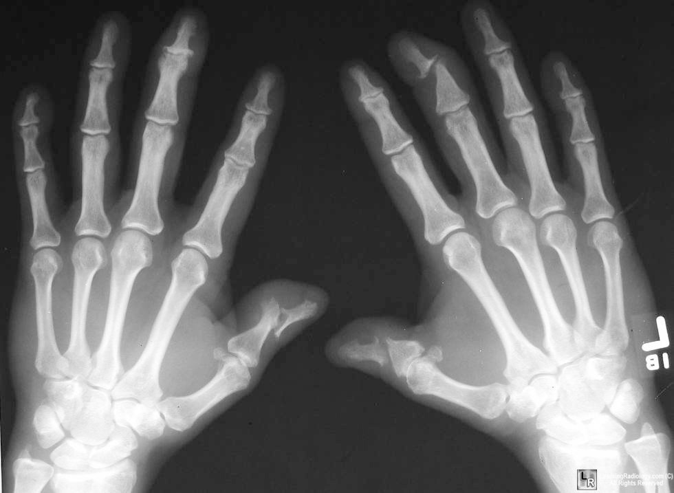 Psoriatic Arthritis Radiology: A Friendly Imaging Guide