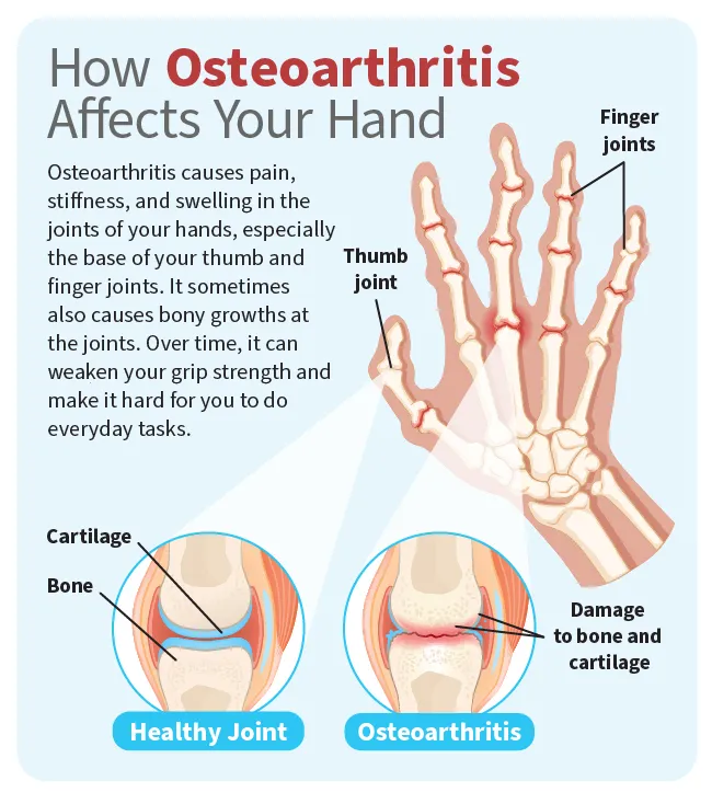Signs of Early Arthritis in Hands Treatment Guide