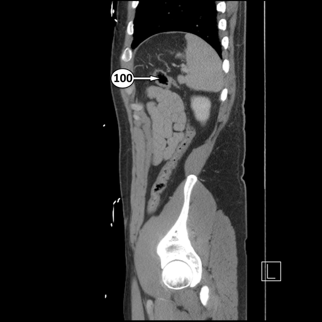Splenic Flexure Syndrome Radiology: Key Facts