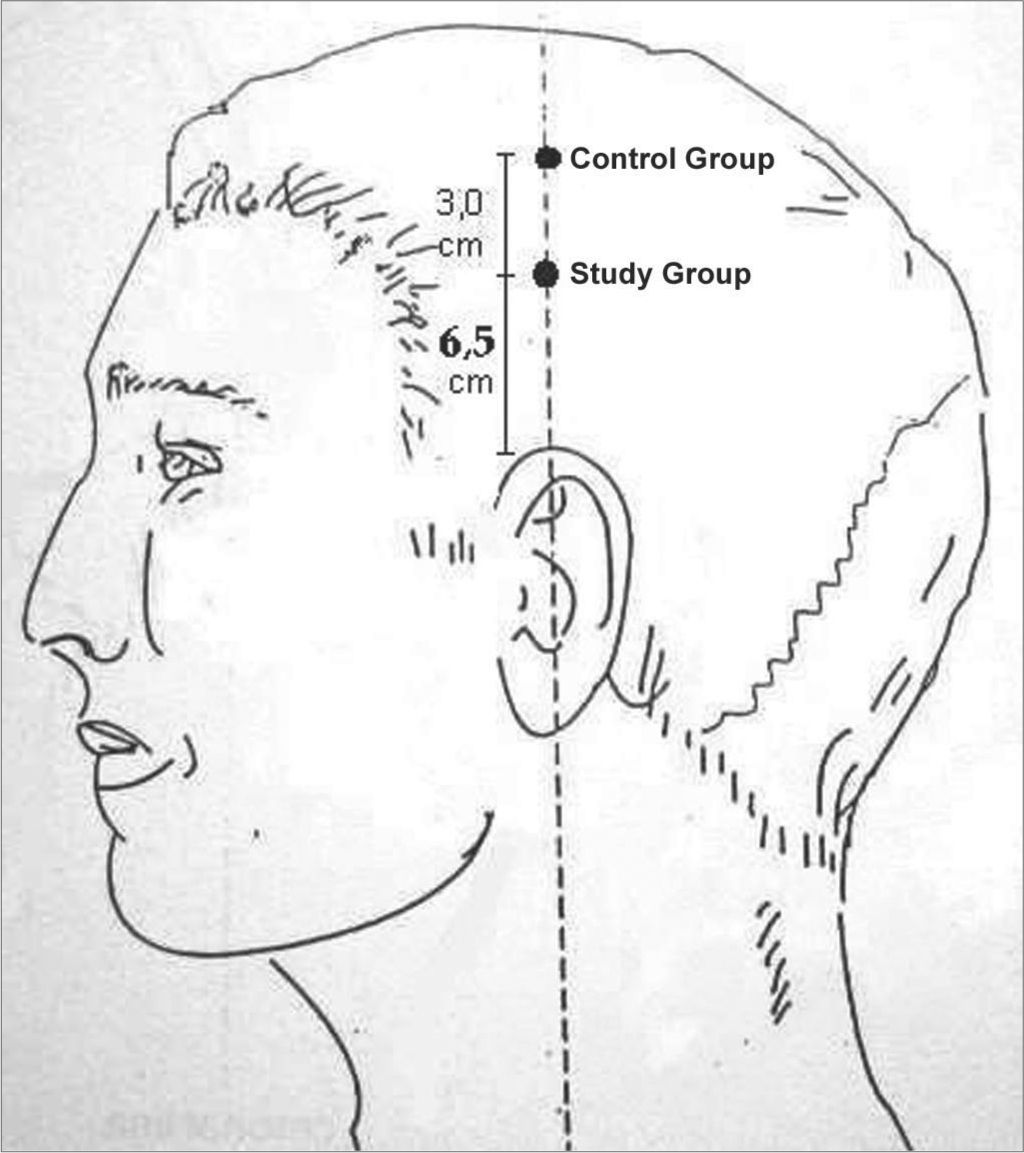 ST 8 Acupuncture Point for Tinnitus – Key Facts