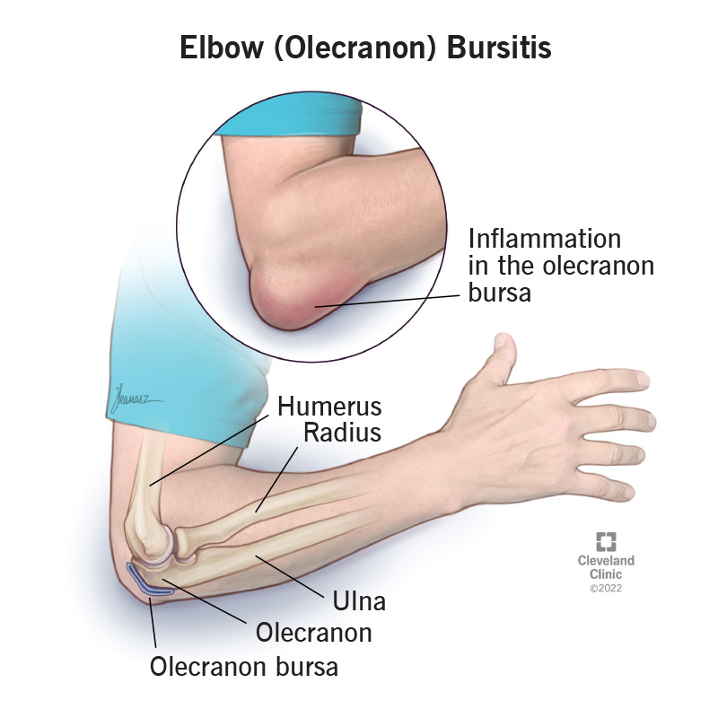 Swollen Painful Elbow Warm to Touch: Causes & Treatment