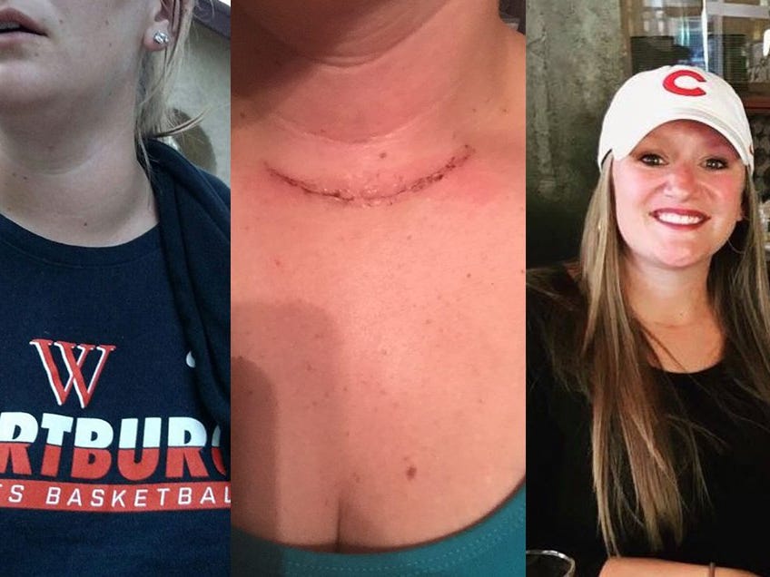 Thyroid Cancer Misdiagnosis Stories – Real Cases & What to Watch For