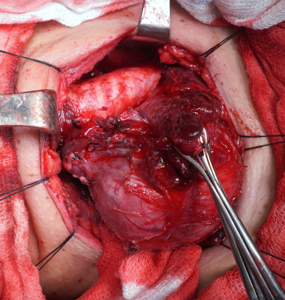 Untreated Thyroid Cancer Life Expectancy: Key Facts