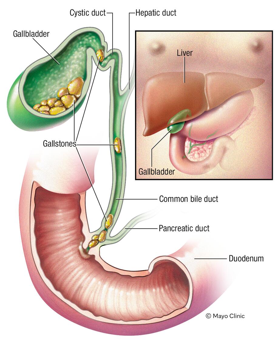 What Causes Gallstones? Quick Answers & Tips for You