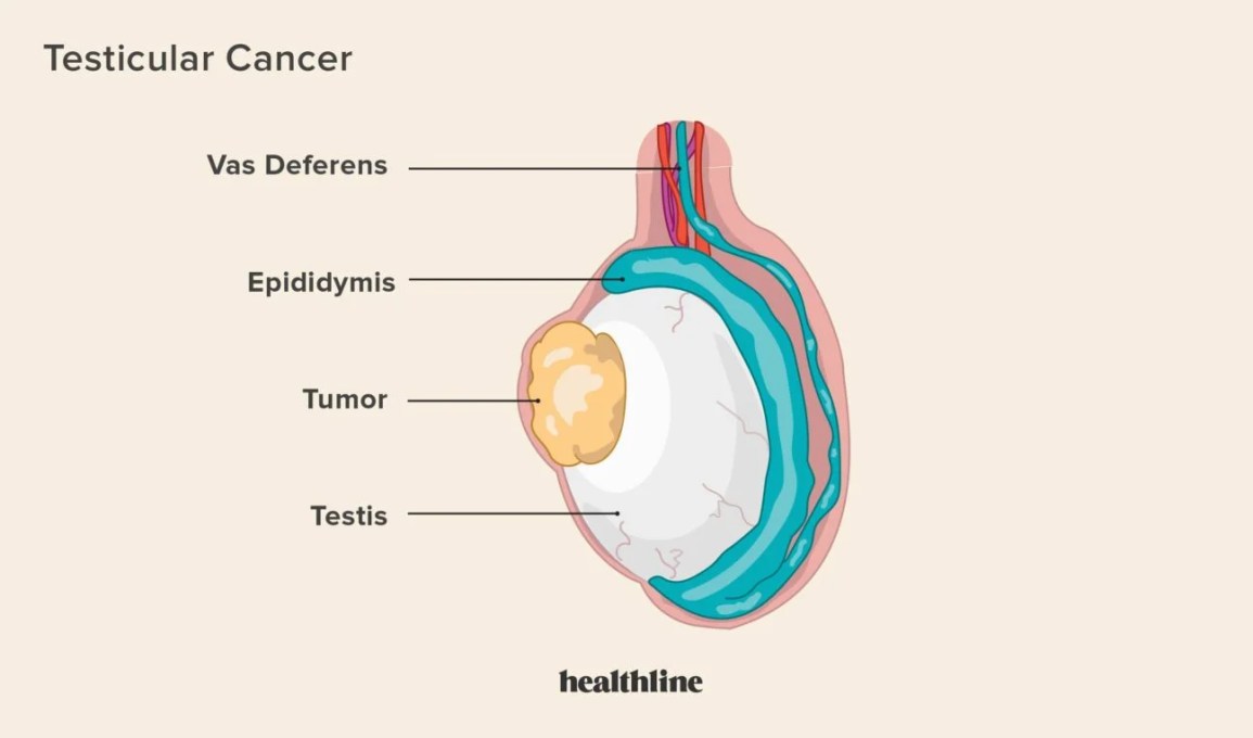 What Does Testicular Cancer Look Like? Know Early Signs