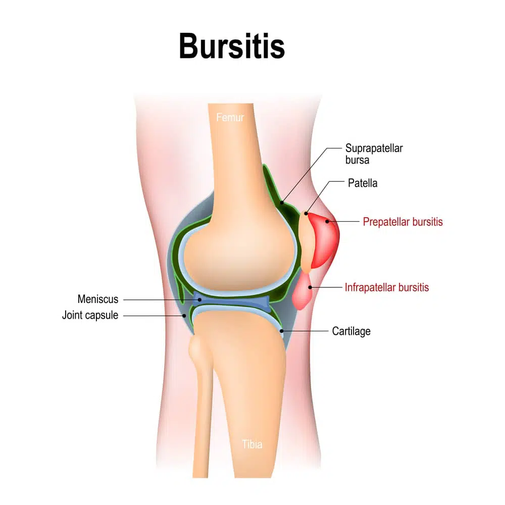 What Is the Fastest Way to Cure Bursitis? Quick Relief Guide
