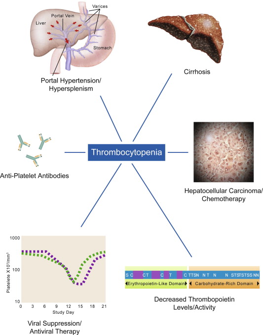 Why Does Cirrhosis Cause Low Platelets? The Real Truth