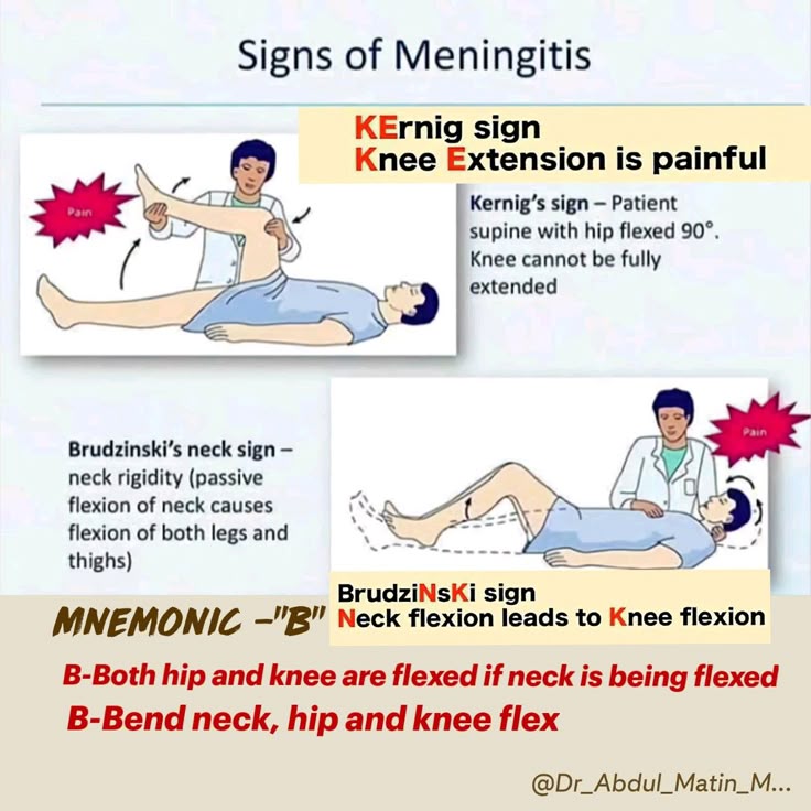 Bruzinski Sign Explained: Meaning, Test, and Clinical Value
