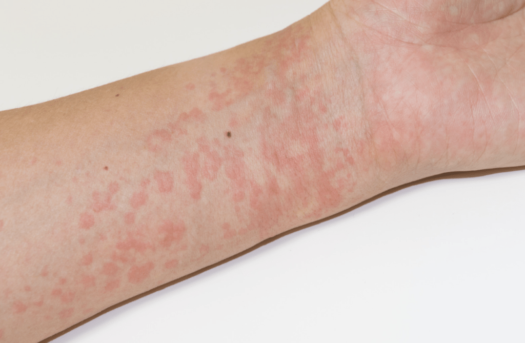 Can Hives Be a Sign of Something Serious in Kids?