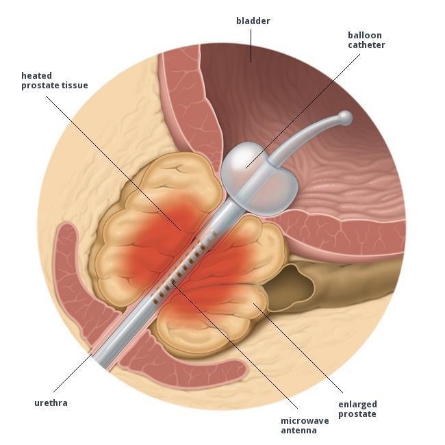 Catheter for Enlarged Prostate and Urinary Retention