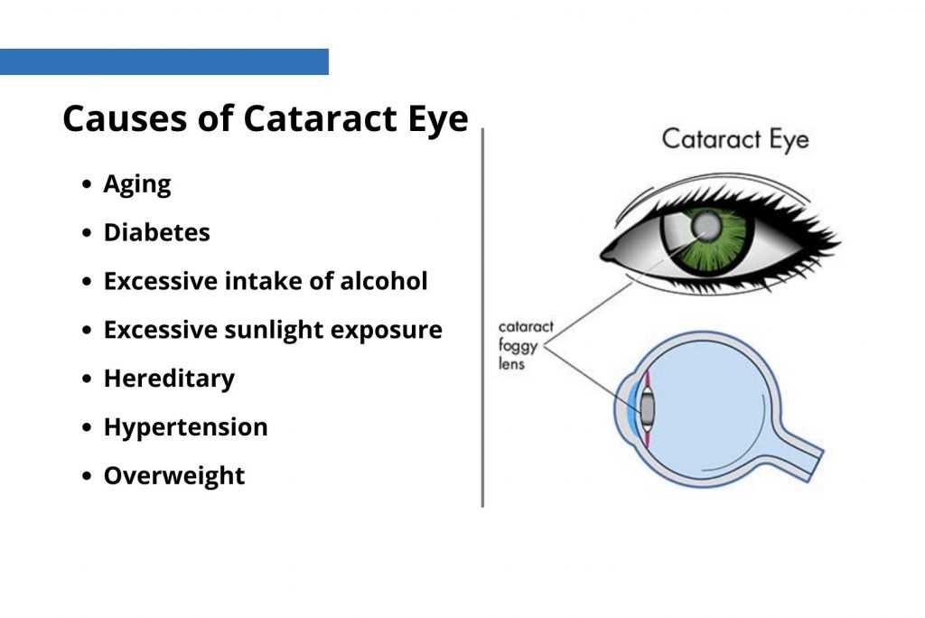 Causes of Cataract: Why Your Vision Might Cloud