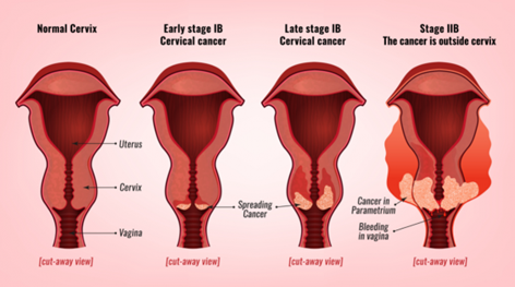 Cervical Cancer Hysterectomy Survival Rate Guide