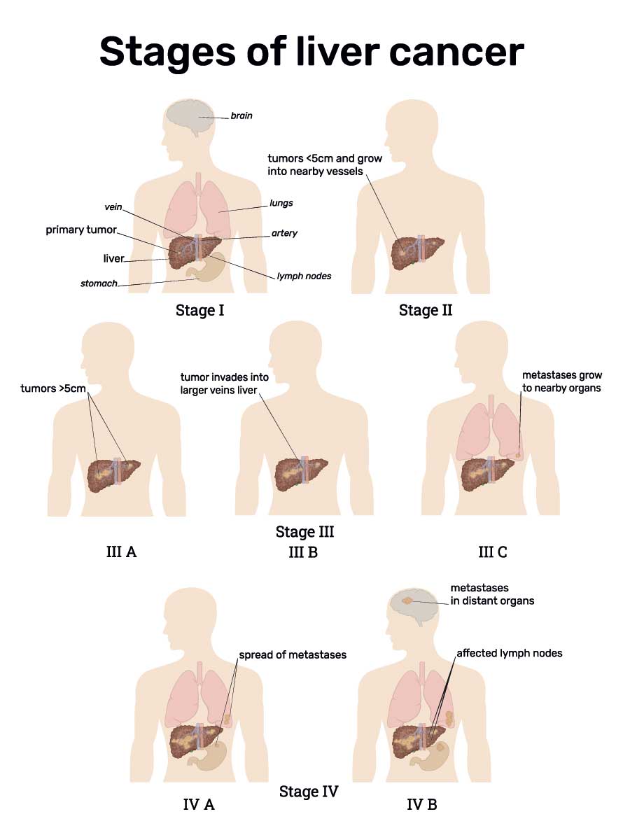 Chemotherapy for Stage 1 Liver Cancer: Key Facts