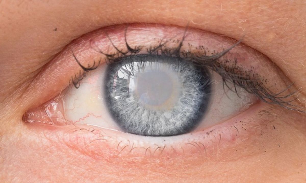 Cortical Cataract: Symptoms, Causes & Treatment