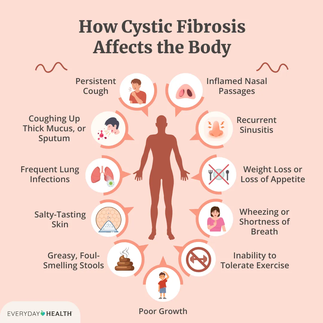 Cystic Fibrosis Symptoms in Babies: Essential Facts