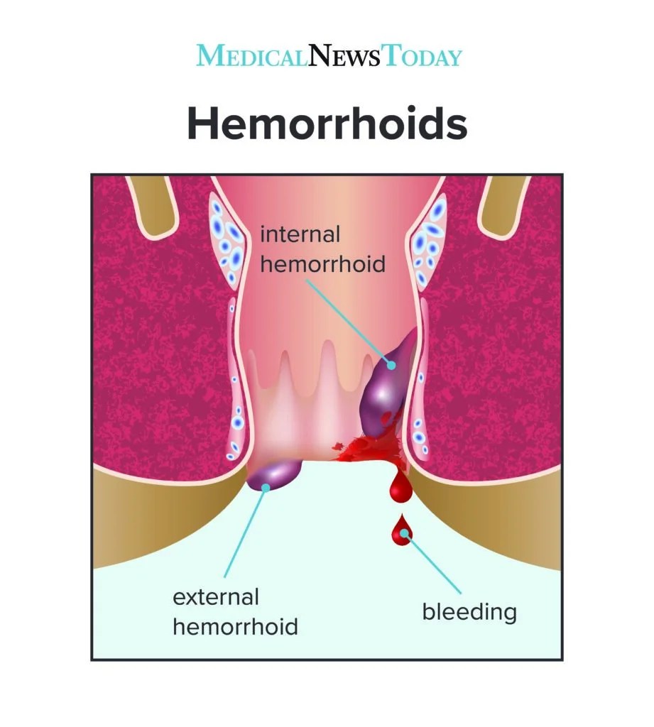 Do Hemorrhoids Itch When They Are Healing? Find Out Why