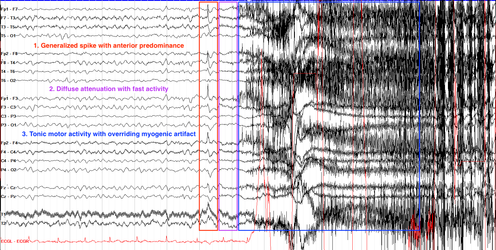 EEG Epilepsy vs Normal: What the Results Really Mean