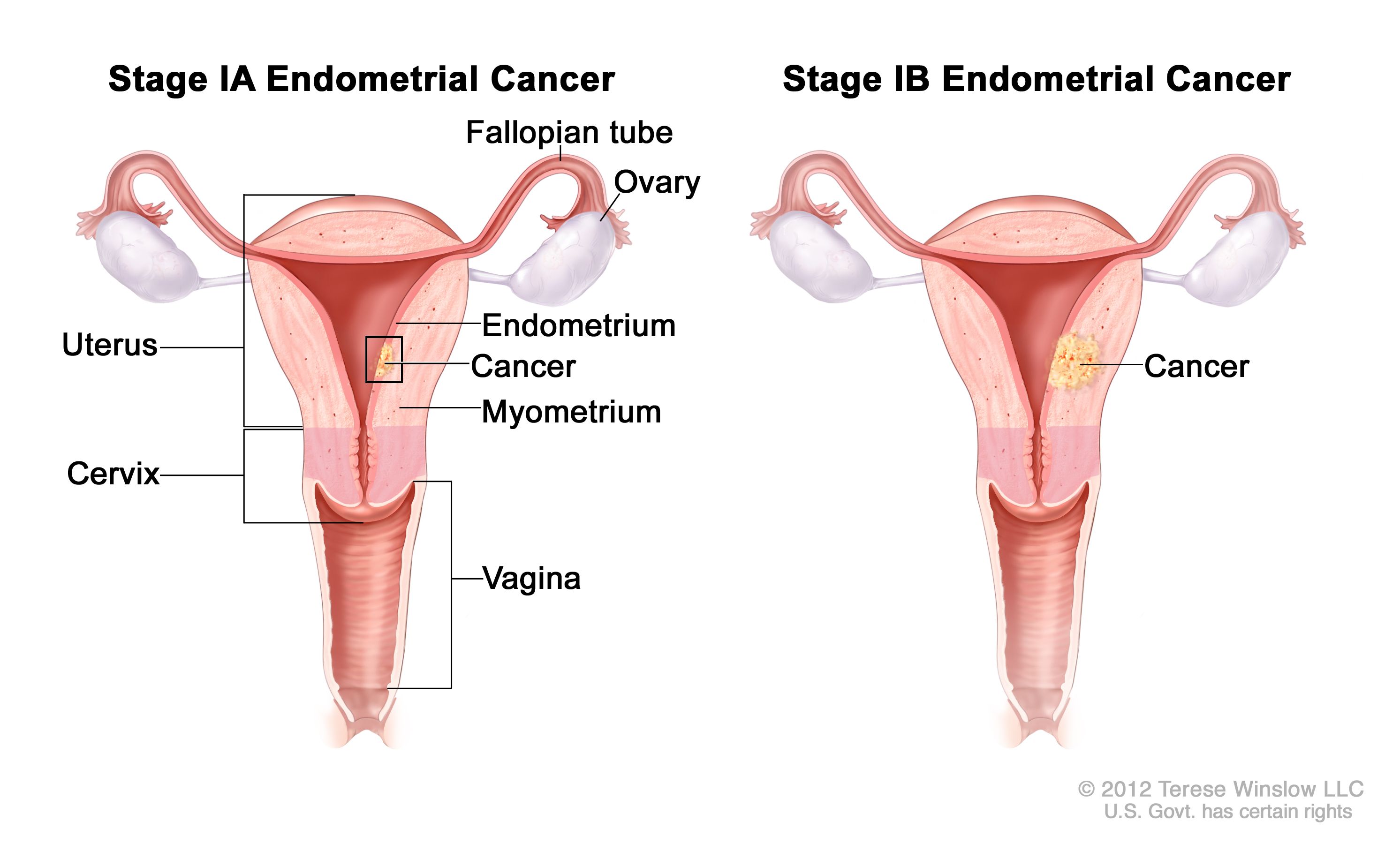 FigO Grade 2 Endometrial Cancer Treatment Guide