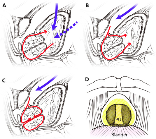Freyer Prostatectomy: A Safer, Faster Way to Heal
